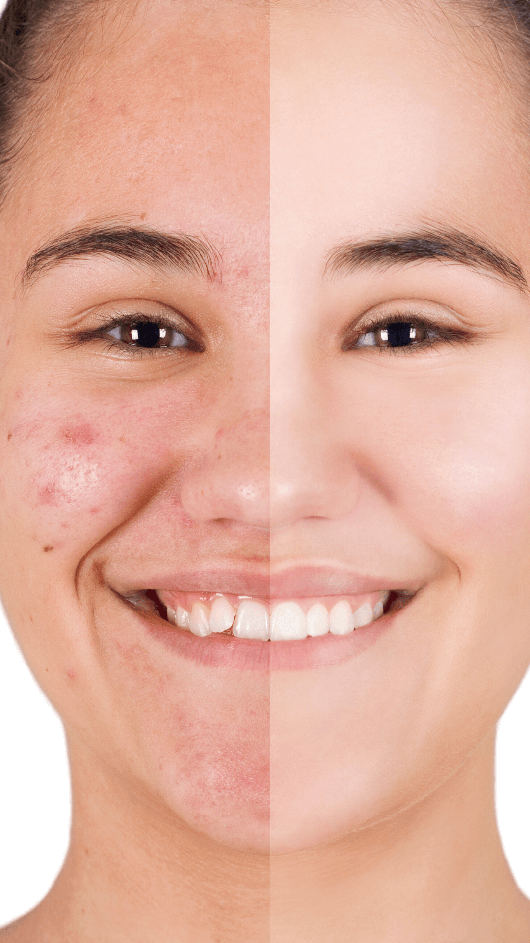 Acne Facial