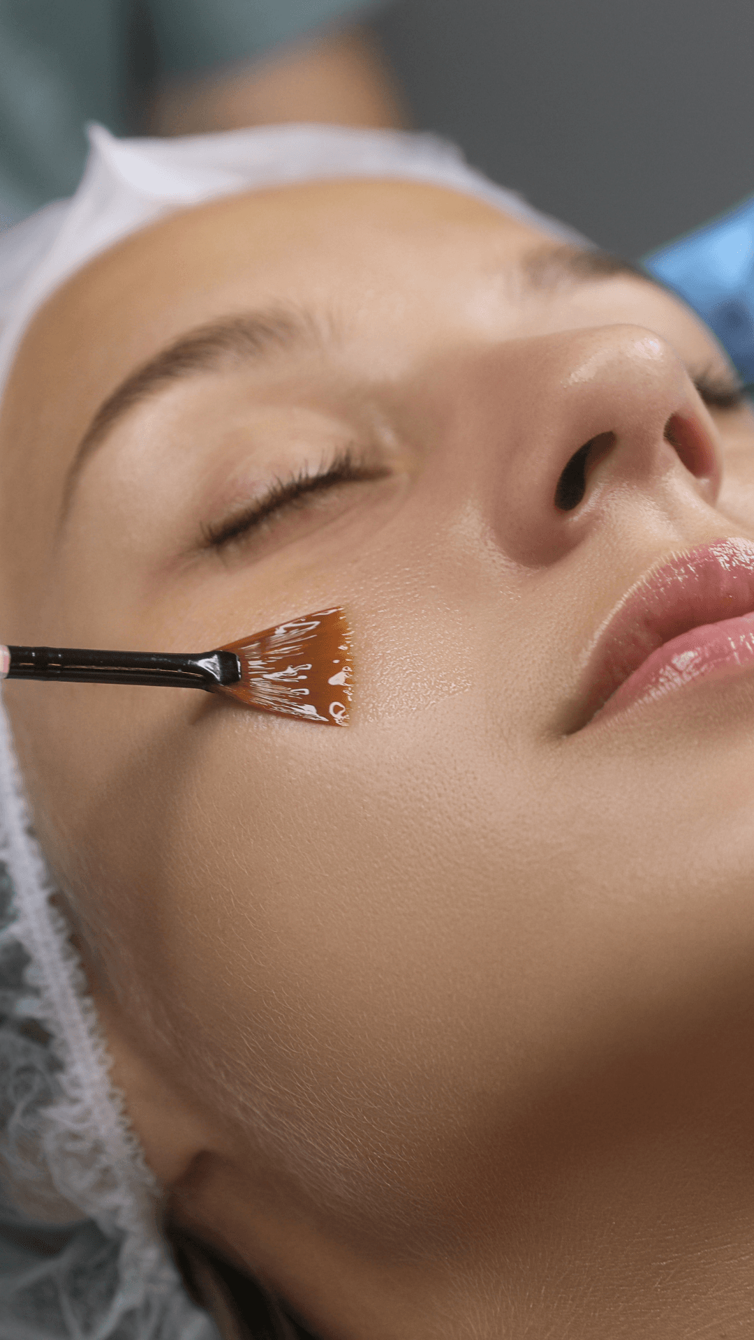 Chemical Peel