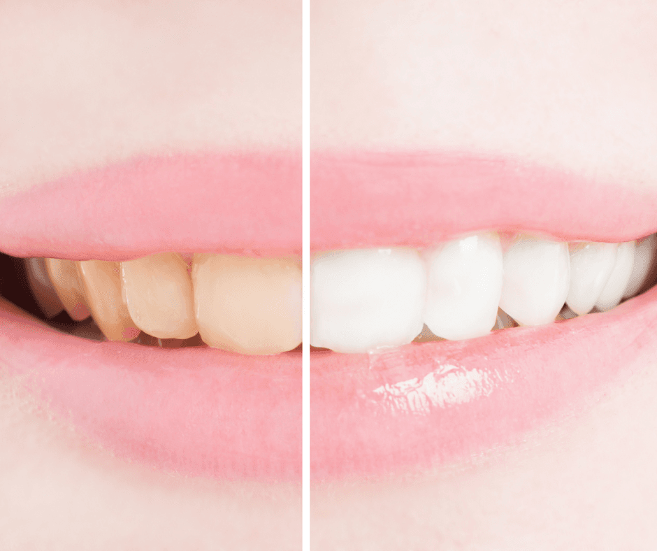 Teeth Whitening