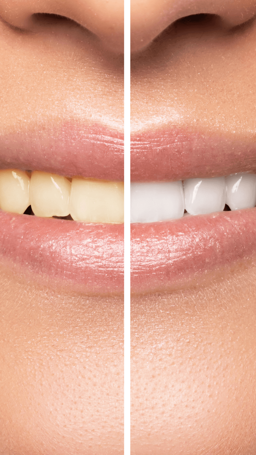 Teeth Whitening